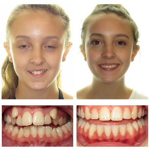 before-after